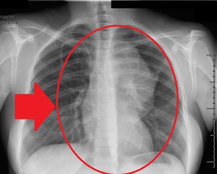 This is the BETTER xray. The one in the office was blurry